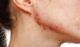 Prevent acne - healthsansar.com